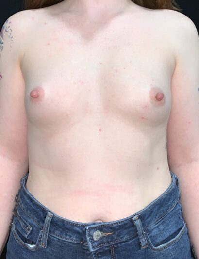 Breast augmentation Submuscular Asheville, North Carolina