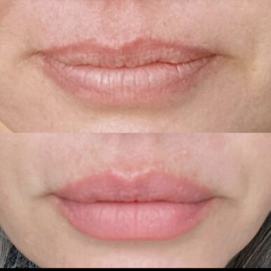 close up of before and after of lip augmentation