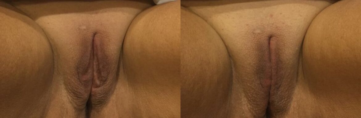 before and after vaginal rejuvenation
