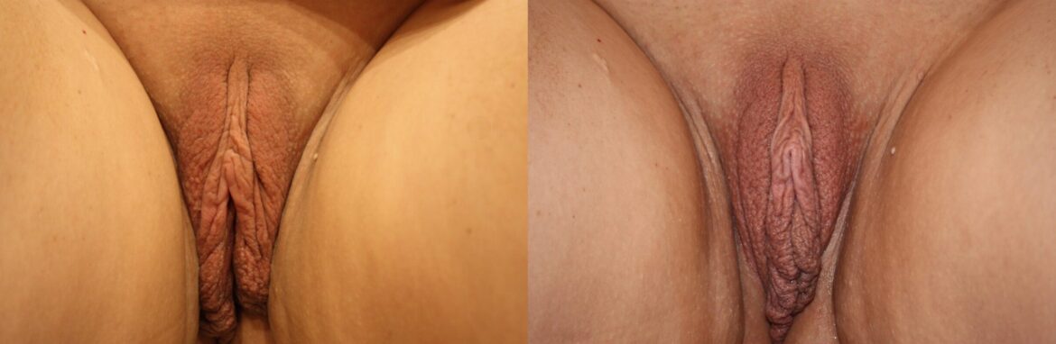 before and after vaginal rejuvenation